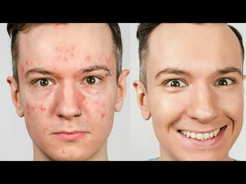 Before and after results from My M.A.T.E Personal Spray - Paradise Nutrients on acne-prone skin.
